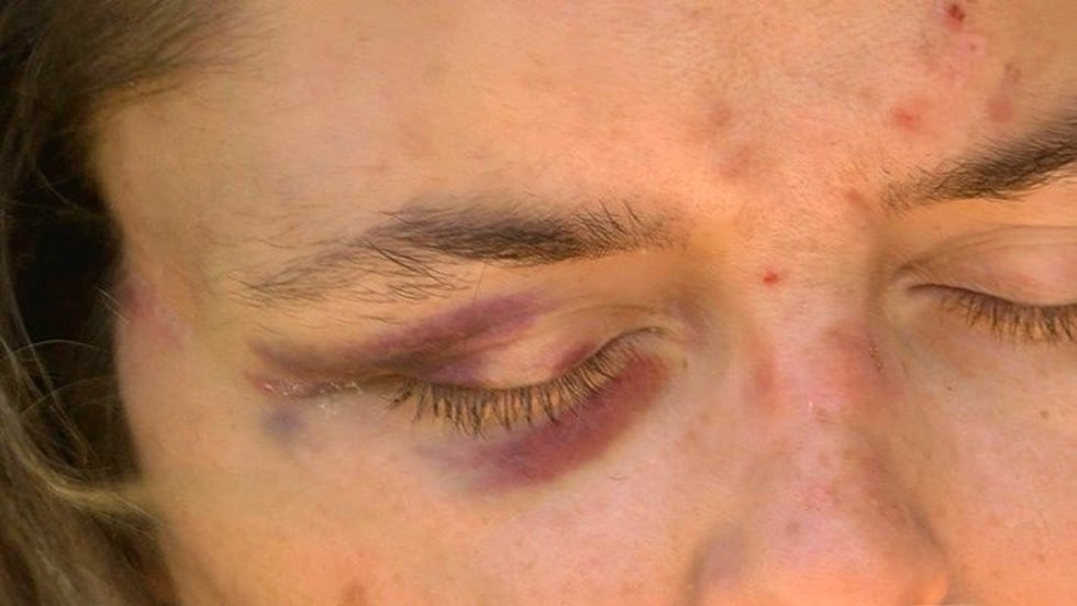 The woman injured in the beating did not want to be identified, but showed us her injuries....