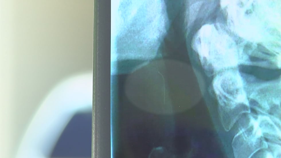 The bristle was lodged in her throat and required emergency surgery to remove. (Source: WAVE 3...